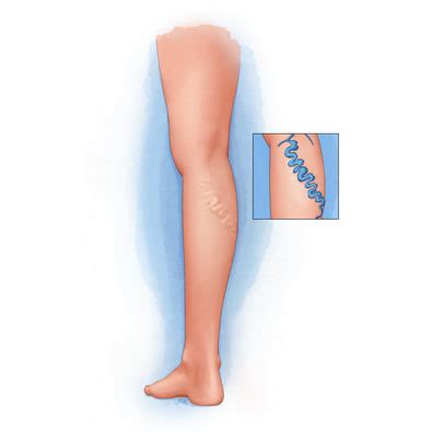 Varicose Vein Disease And Treatments Ivc Interventional Vascular And