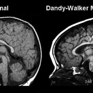 Figure 10: MRI radiography image of the head and skull of a person with Dandy-Walker syndrome ...