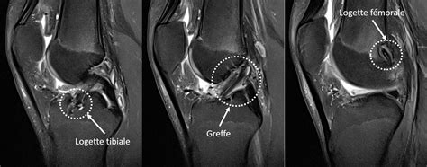 La Rupture Du Ligament Croisé Antérieur De Lenfant