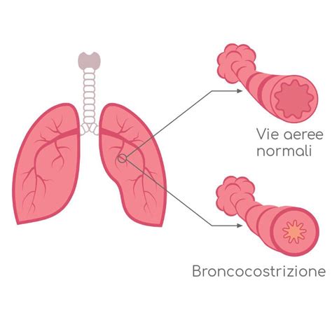 Bronchite Cronica Cos Sintomi Cause E Cure