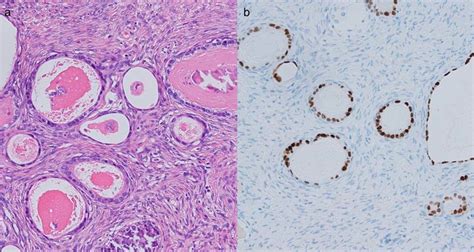 Histological Evaluation Of Resected Ovarian Tissues A Hematoxylin