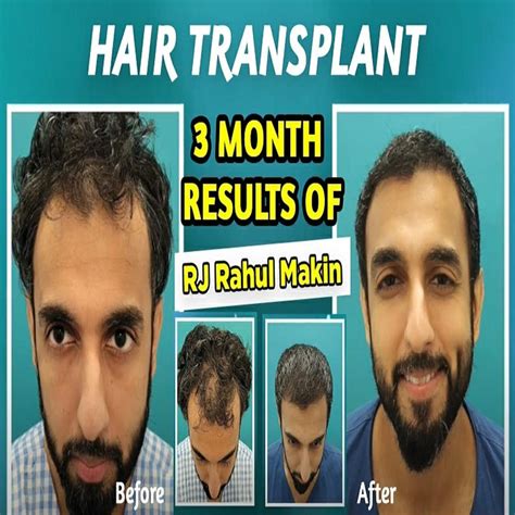 Top 176 Famous Hair Transplant In India