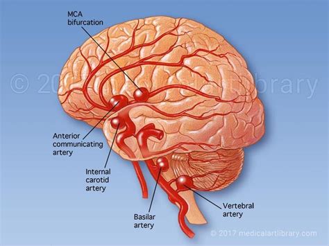 Anterior Communicating Artery Stroke Mapametawan