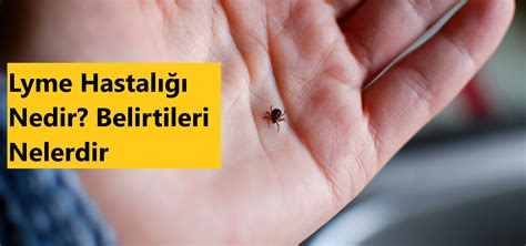 Lyme Hastalığı Nedir Belirtileri Nelerdir edoktorTV