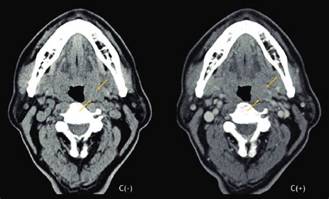 Neck Computed Tomography Ct Scan Revealed A 29 Â 20 Mm Homogenous Download Scientific Diagram