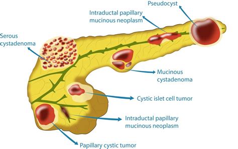 Pancreas Specialist Perth Pancreas Disorders Surgeons And Specialists