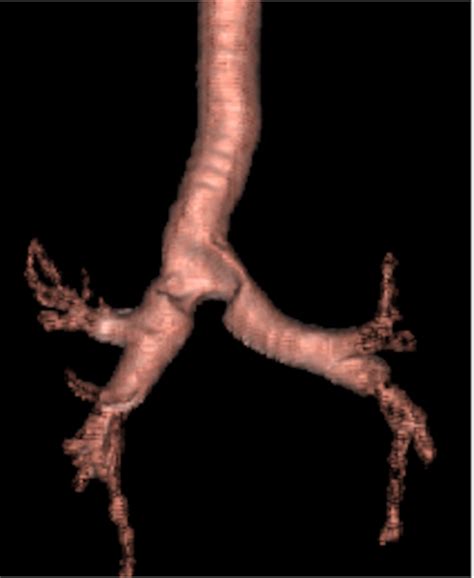 A Voluminous Tumour Of The Tracheal Bifurcation Bouanzoul 2022