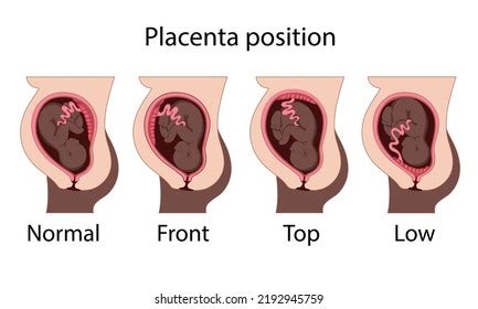 Different Placental Locations Fetus Uterus During Stock Vector Royalty