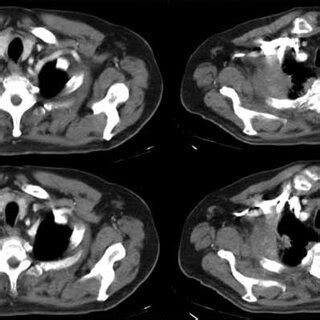 -Computed tomography scan showing the superior sulcus tumor in the ...