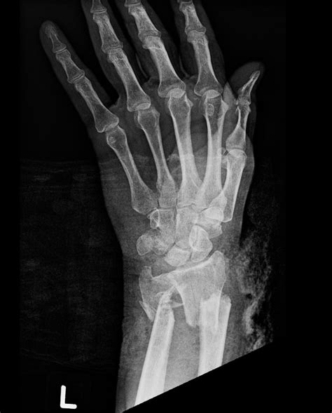 Distal Radius Fractures Brown Emergency Medicine