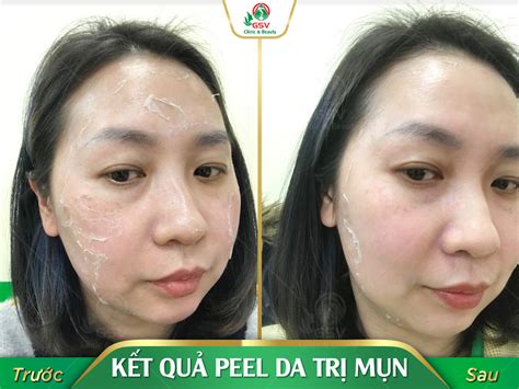 Top 11 sản phẩm peel da tốt nhất hiện nay Da liễu thẩm mỹ GSV