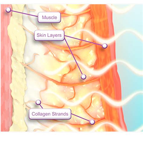 Thermage - DR SIN YONG