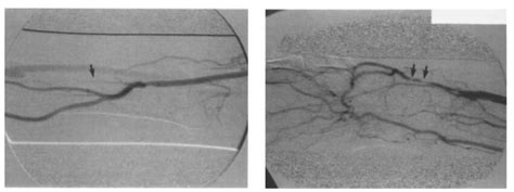 Benefits Of A Pan Angiographic Demonstration Of The Fistula Extremity