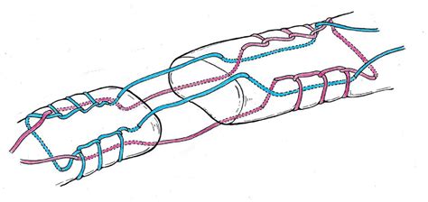 Achilles Tendon Rupture Repair Biomechanical Comparison Of The Locking