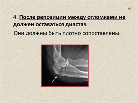 Основные принципы и методы лечения переломов костей - презентация онлайн