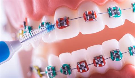 The Average Cost Of Braces Ries Orthodontics