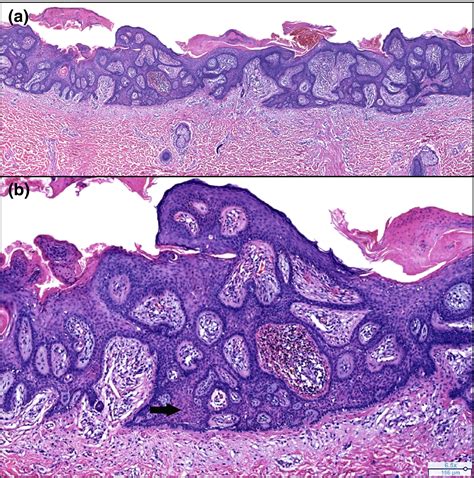 Tumor Of The Follicular Infundibulum