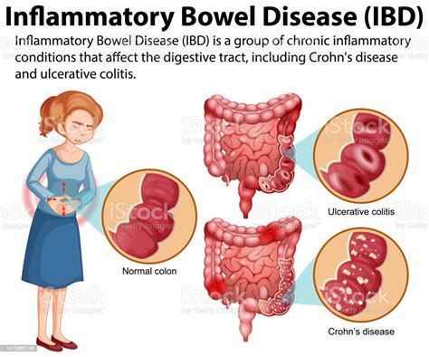 Infografis Penyakit Radang Usus Ilustrasi Stok Unduh Gambar Sekarang