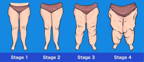 Lipedema Liposuction - What is Lipedema Treatment – Estheticland