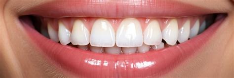 Premium Photo | Perfect Smile with Dental Veneers
