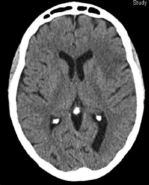 CT scan of the brain. | Download Scientific Diagram