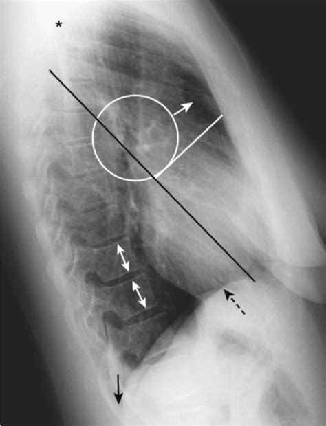 Normal Left Lateral CXR Diagram Quizlet