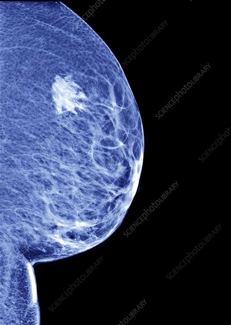 Breast Cancer Mammogram