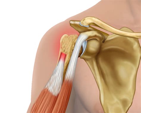 Orthopaedic & Trauma Surgeon - Elbow - Distal biceps rupture