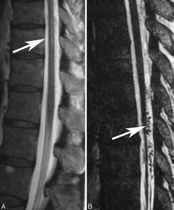 Spinal dural AVF | Spinal