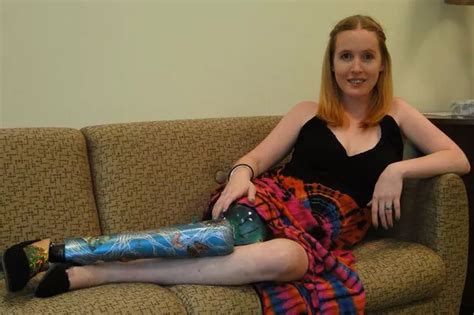 Woman Throws Farewell Party For Leg Before Having It Amputated World News Mirror Online