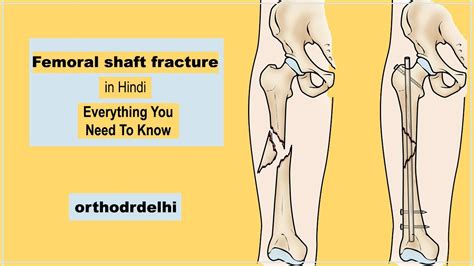 Femur Fracture Treatment Femur Shaft Fractures Broken Thighbone In