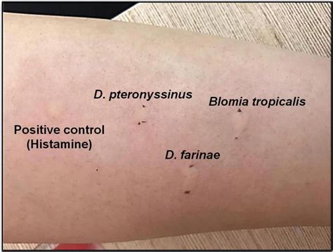 Positive Spt Of Hdm Allergen Dermatophagoides Pteronyssinus D