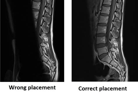 Mri Saturation Band Artifacts