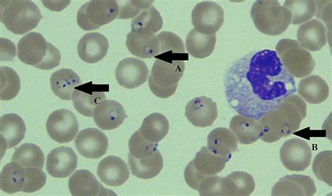 Plasmodium Falciparum Ring Stage Labeled