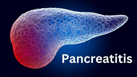 Pancreatitis Everything You Need To Know Youtube