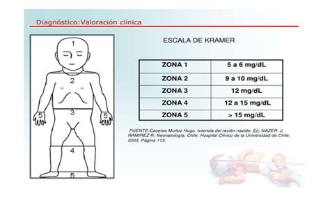 Ictericia Del Recien Nacido Pptx