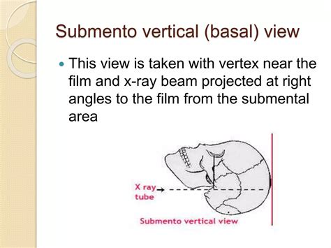 Radiology Of Nose And Paranasal Sinuses Ppt