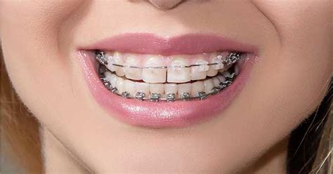 Que Tipos De Brackets Existen Y Cuales Son Sus Diferencias Clinica Images