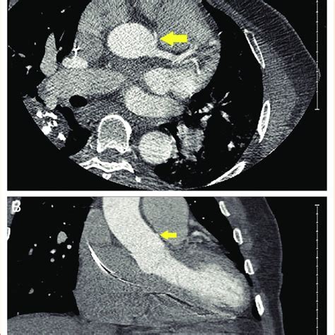 Coronary CT Angiography A | Download Scientific Diagram