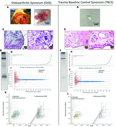 The profile of OA synovium (OAS) and trauma baseline control synovium... | Download Scientific ...