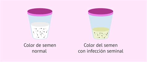 Qué es la normozoospermia Valores de referencia en el seminograma