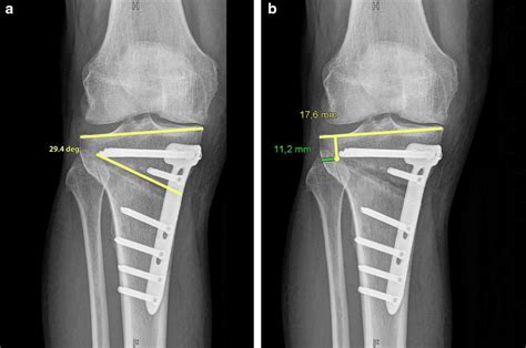 Radiological Measurements Using The Example Of Owhto With Type A Foh