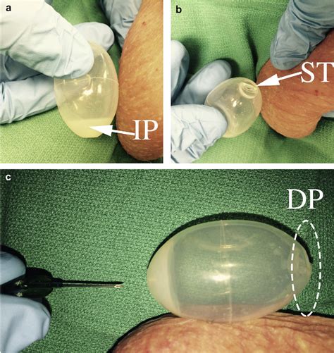 Figure 1 From Percutaneous Revision Of A Testicular Prosthesis Is Safe