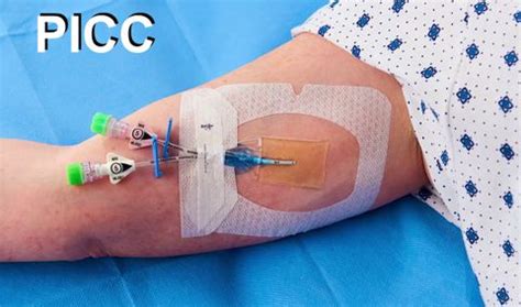 Picc Catheter