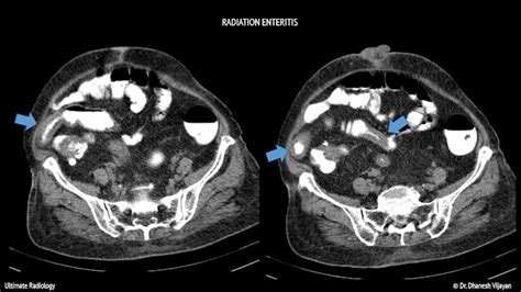 Ultimate Radiology Radiation Enteritis