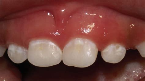 Pathways For The Management Of Early Childhood Caries