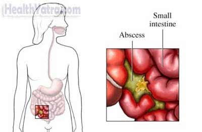 Actinomycosis Definition, Causes, Symptoms & Treatment Cost in India ...