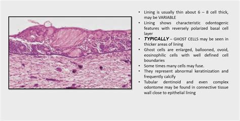 Calcifying Odontogenic Cyst Histopathology