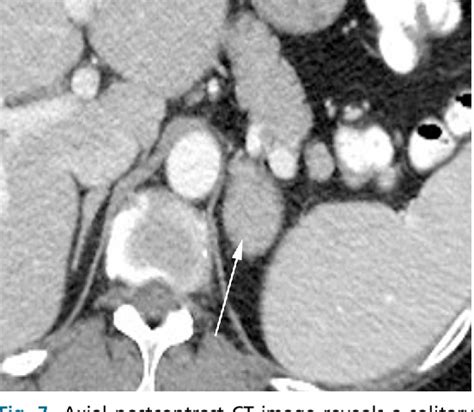 Table 1 From Imaging Of Extranodal Genitourinary Lymphoma Semantic Scholar