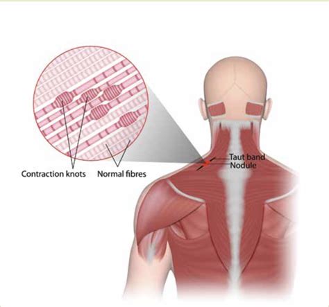 Dry Needling For Myofascial Pain And Dysfunction Gareth Warburton